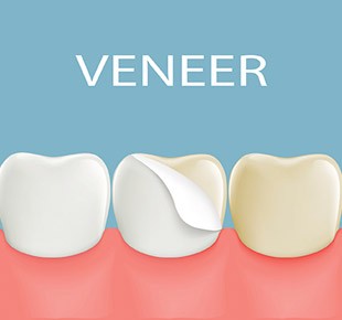Dental Veneers Baton Rouge